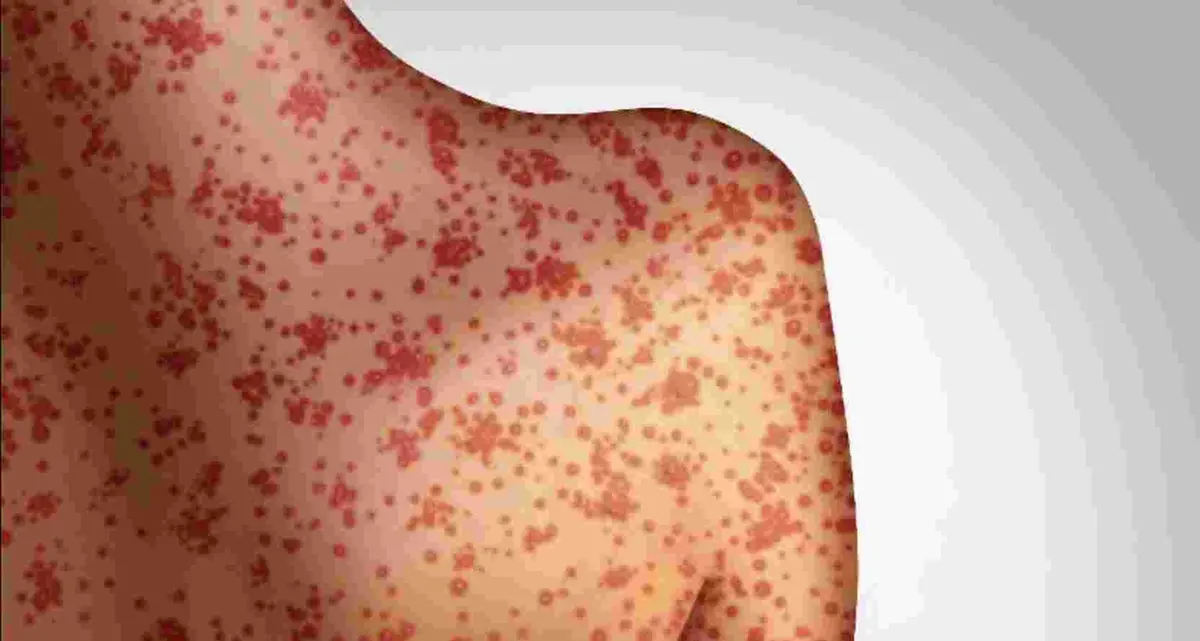 Dopo New York l’allarme morbillo arriva a Chicago, Los Angeles e Miami